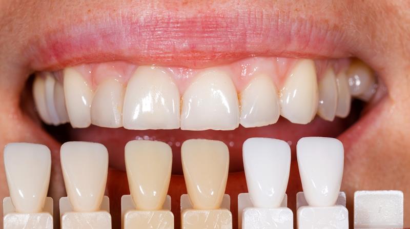 Veneers Surrey, BC VR Z